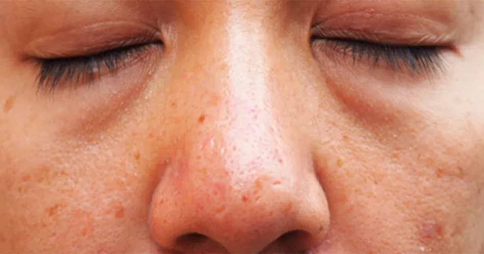 هكذا تواجهين تورم الوجه في الصباح 1 2 155